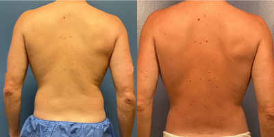Liposuction before and after photo