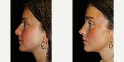Septoplasty before and after photo