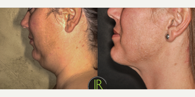 Chin Liposuction before and after photo