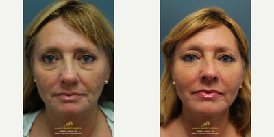 Facelift before and after photo