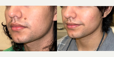 Mole Removal before and after photo