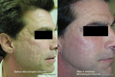 Scar Removal before and after photo