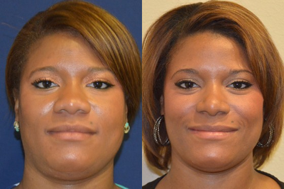 African American Rhinoplasty before and after photo