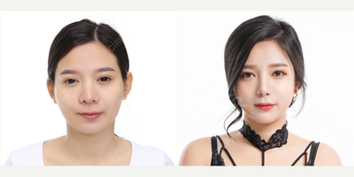 Double Eyelid Surgery before and after photo