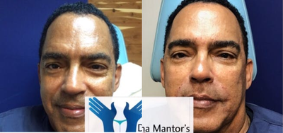 Juvederm before and after photo