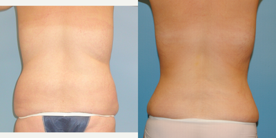 Liposuction before and after photo