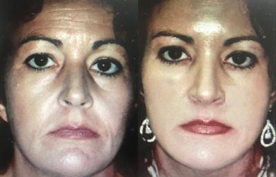 Bellafill before and after photo