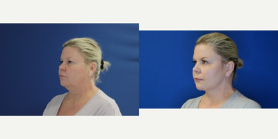 Deep Plane Facelift before and after photo