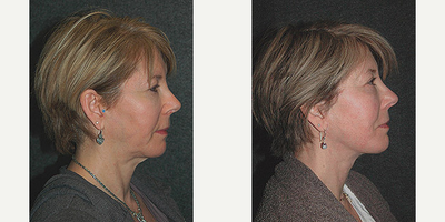 Facelift before and after photo