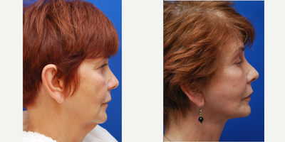 Facelift before and after photo