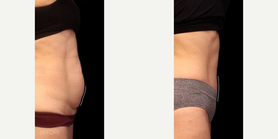 Tummy Tuck before and after photo