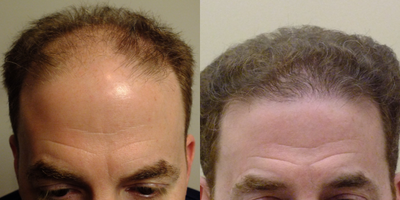 ARTAS Robotic Hair Transplant before and after photo