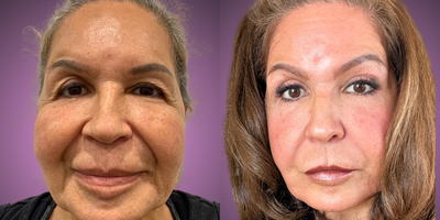 Buccal Fat Removal before and after photo