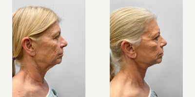 Facelift before and after photo