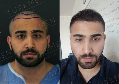 Hair Transplant before and after photo