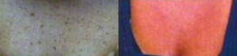 IPL before and after photo