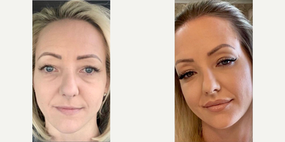 Lip Fillers before and after photo
