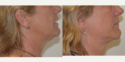 Neck Lift before and after photo