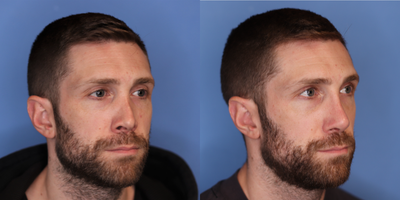 Revision Rhinoplasty before and after photo