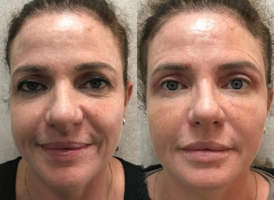 Eyelid Surgery before and after photo