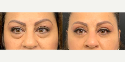 Eyelid Surgery before and after photo