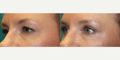 Eyelid Surgery before and after photo