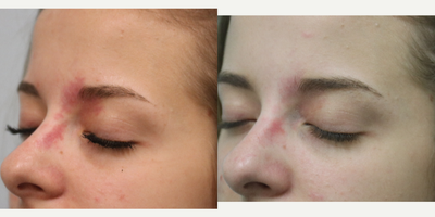 IPL before and after photo