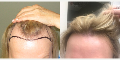 NeoGraft before and after photo