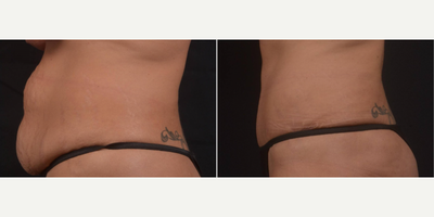 Tummy Tuck before and after photo
