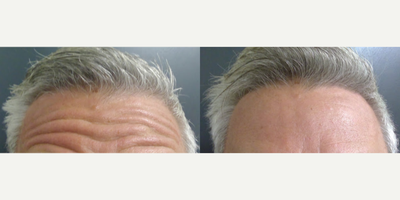 Botox before and after photo