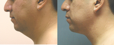Chin Liposuction before and after photo