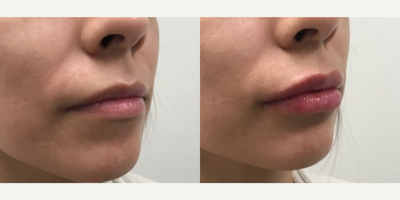 Juvederm before and after photo