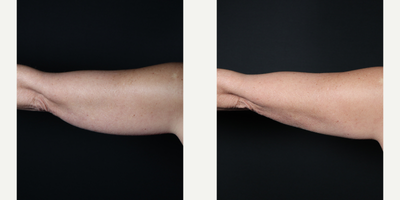 CoolSculpting before and after photo