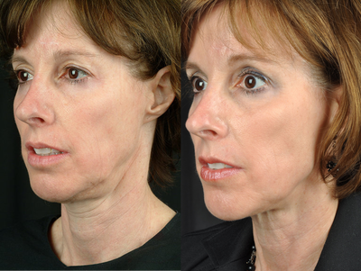 Fractional Laser before and after photo