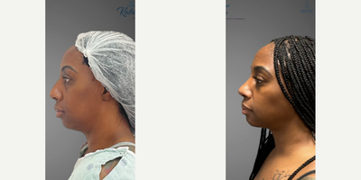 Rhinoplasty before and after photo