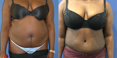 Tummy Tuck before and after photo
