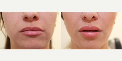 Volbella before and after photo