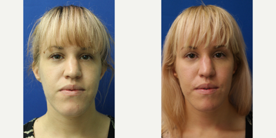 Cheek Lift before and after photo