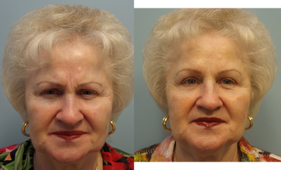 Dysport before and after photo