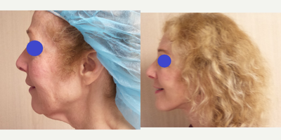 Facelift before and after photo