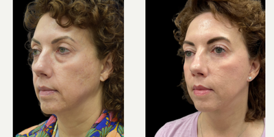 Facelift before and after photo