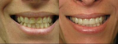 Teeth Whitening before and after photo