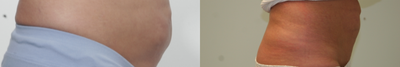 CoolSculpting before and after photo