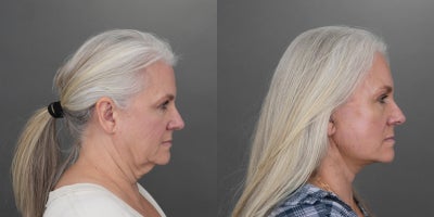 Deep Plane Facelift before and after photo