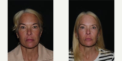 Eyelid Surgery before and after photo