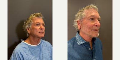 Facial Fat Transfer before and after photo