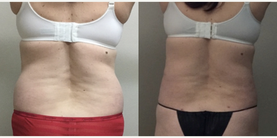 Laser Liposuction before and after photo