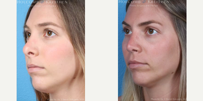 Rhinoplasty before and after photo