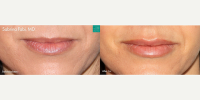 Belotero before and after photo