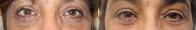 Eyelid Surgery before and after photo